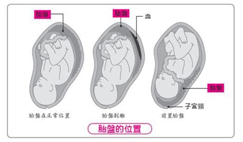 胎盤剝離方式|胎盤問題全解析